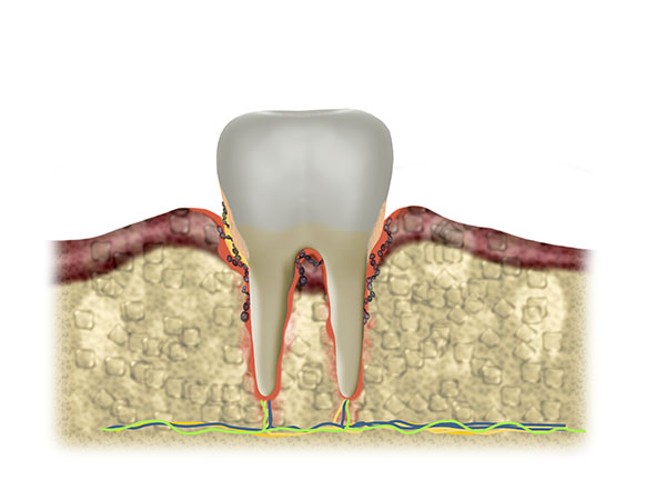 Fog&iacute;nygyullad&aacute;s - Soproni fogorvos
