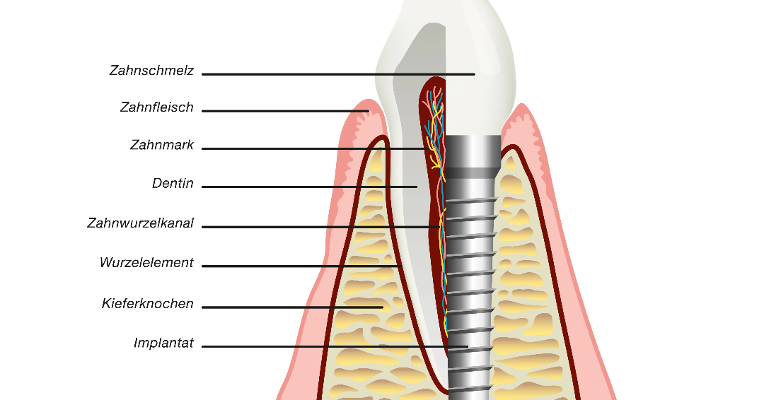 Zahnimplantat Beschreibung Sopron