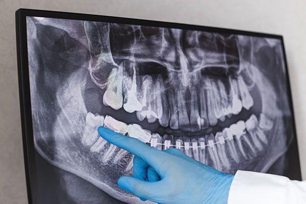 Dental foci - Sopron - dentist