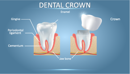 Dental crown by dentist in Sopron